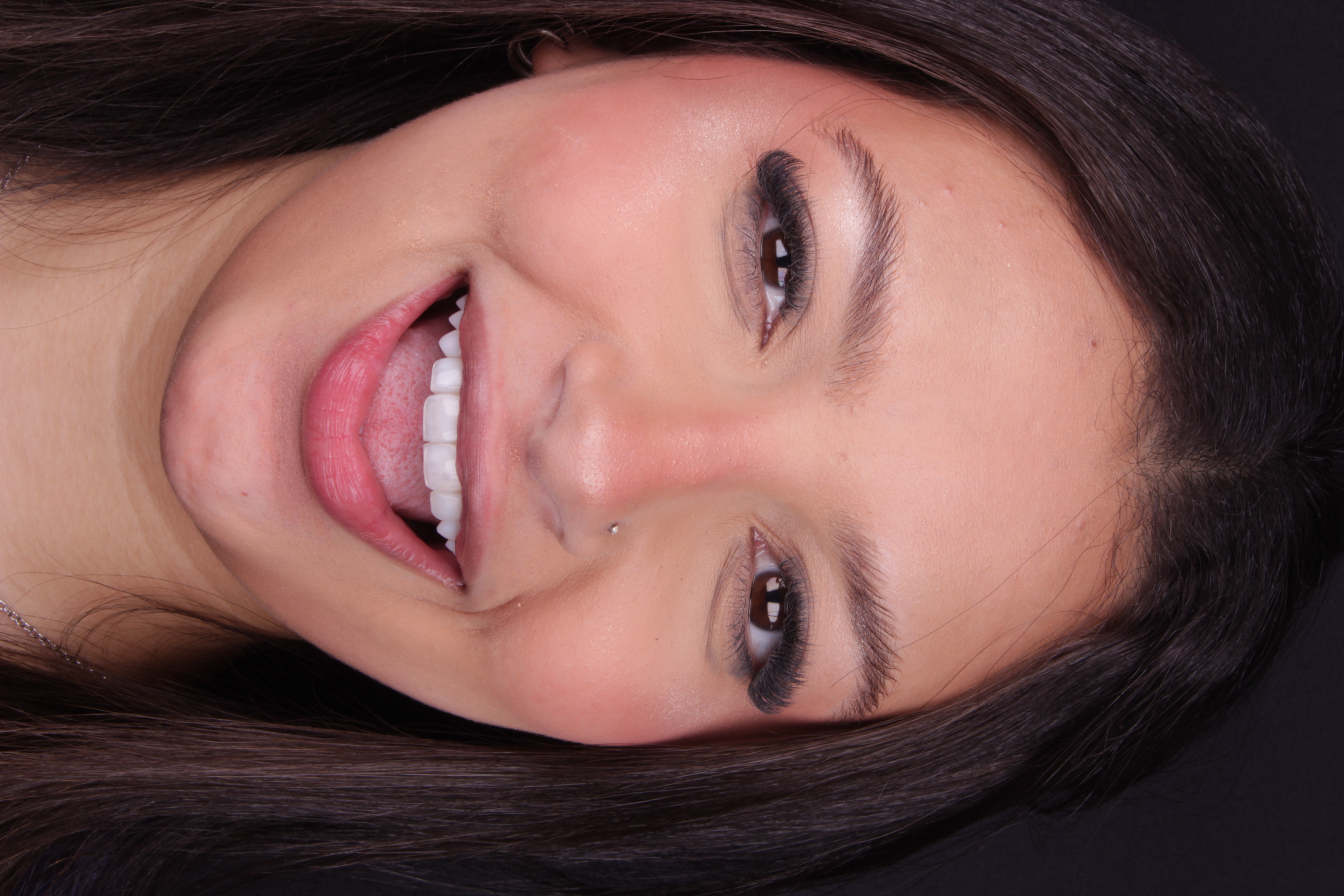 Sorriso depois da lente de contato dental sob luz natural