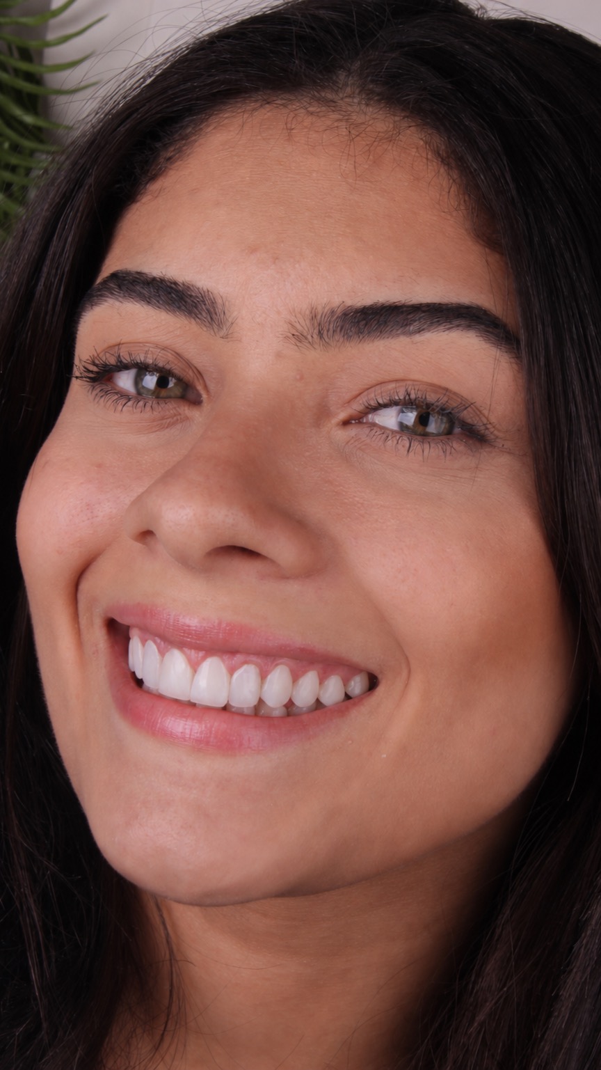Lente de contato dental em ambiente natural
