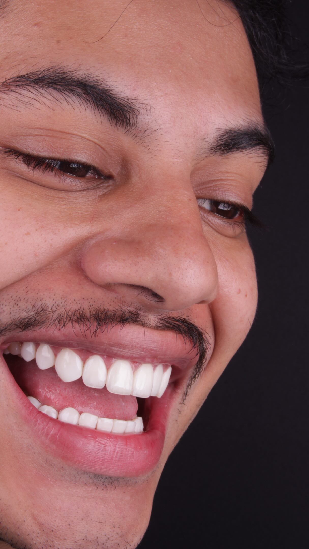 Sorriso descontraído com lente de contato dental
