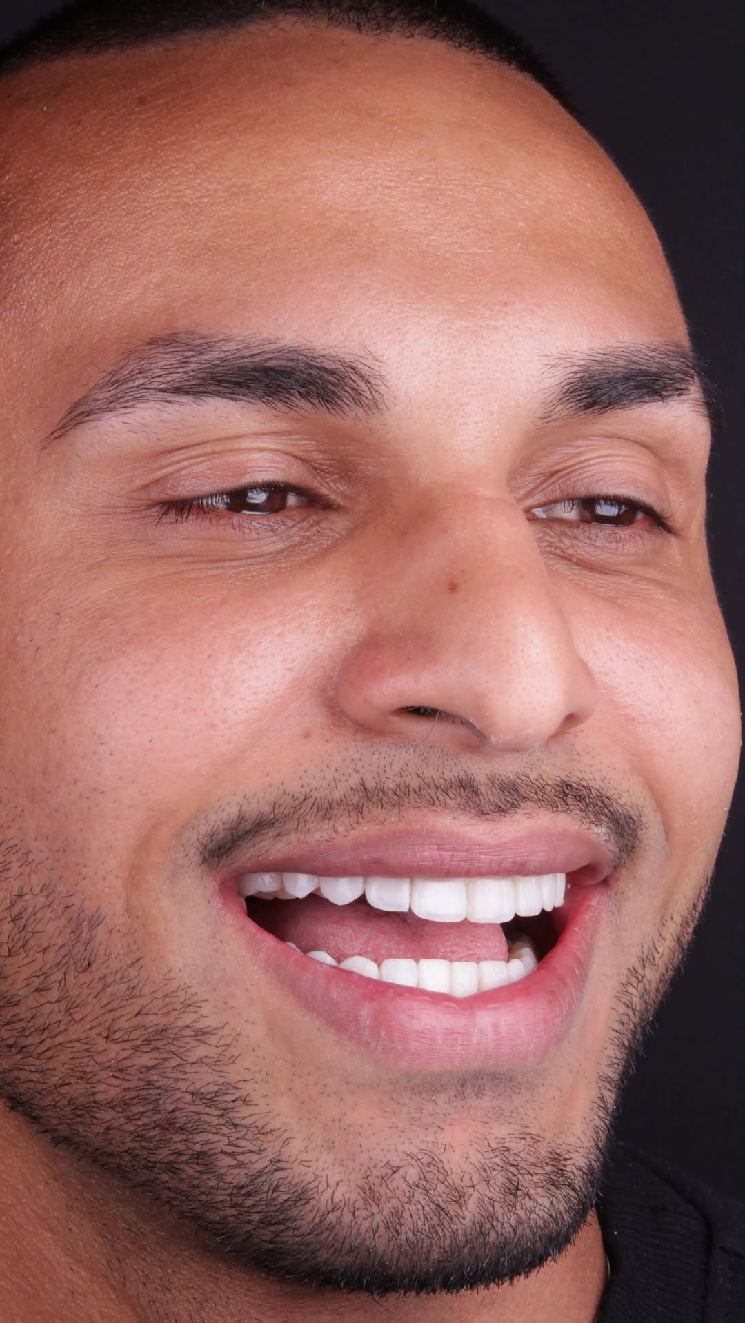 Sorriso espontâneo com lente de contato dental