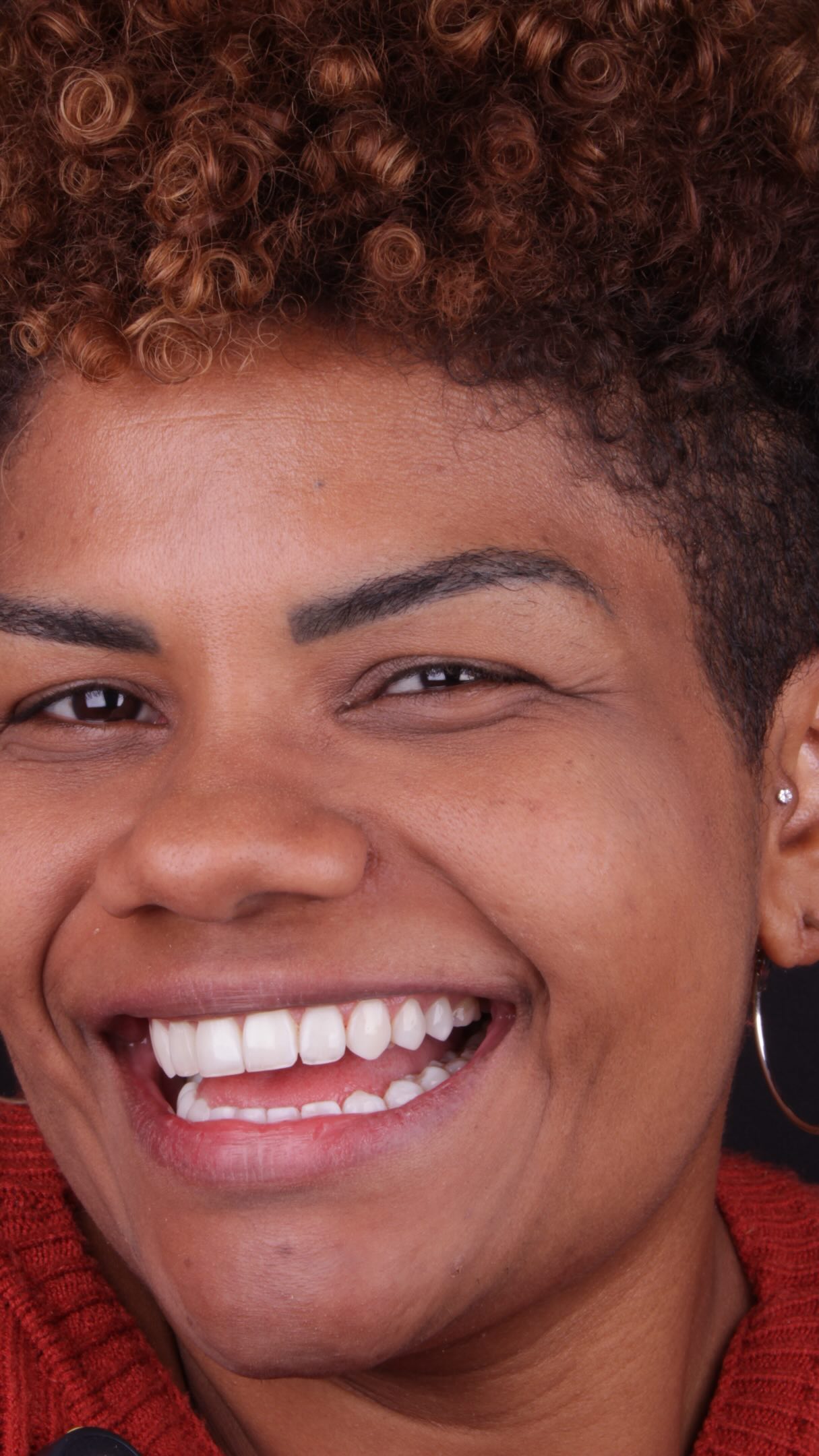 Sorriso vibrante com lente de contato dental